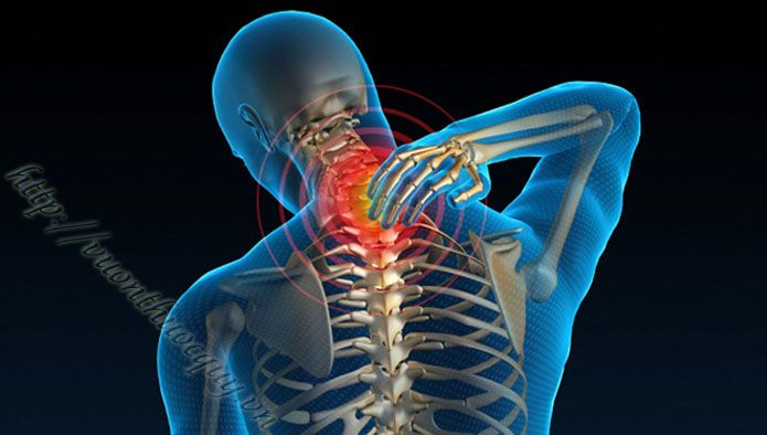 thoái hóa đốt sống cổ