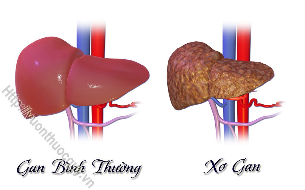 bệnh xơ gan là gì ?