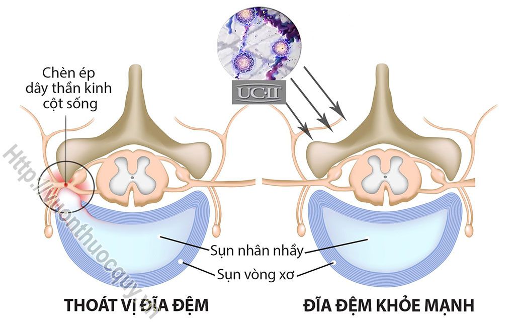 cứng khớp
