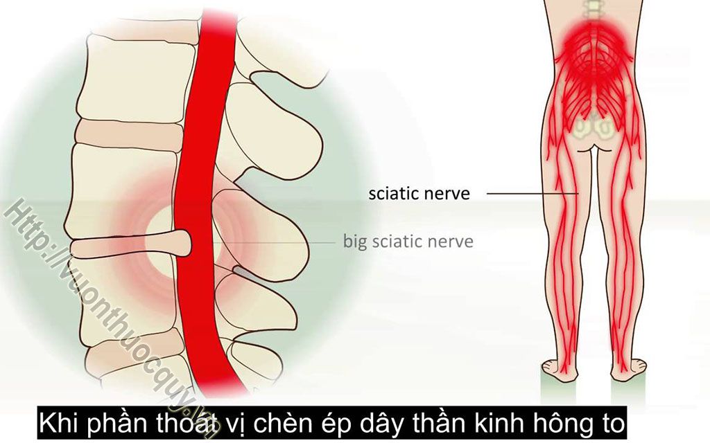 bệnh thoát vị đĩa đệm là gì