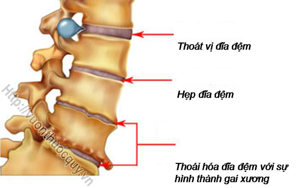 thoát vị đĩa đệm