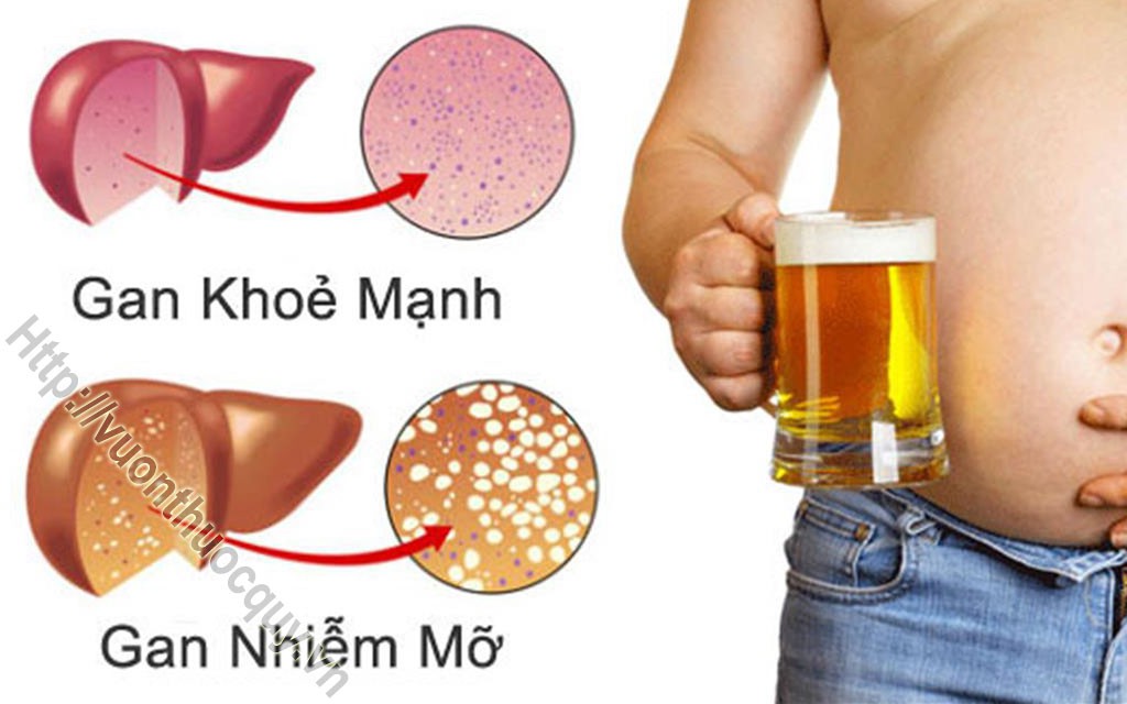 triệu chứng gan nhiễm mỡ độ 1
