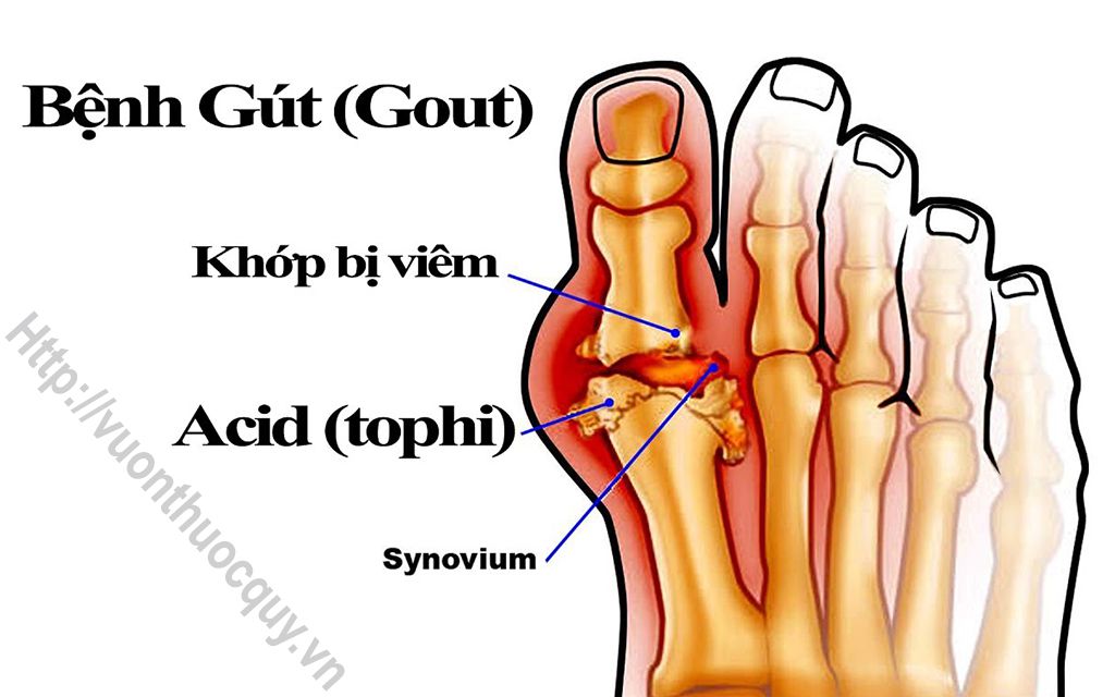Bài Thuốc Hay Hỗ Trợ Điều Trị Bệnh Gout