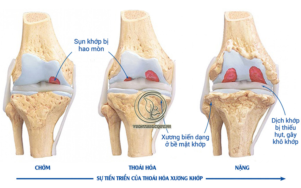 Biến Chứng Của Bệnh Xương Khớp
