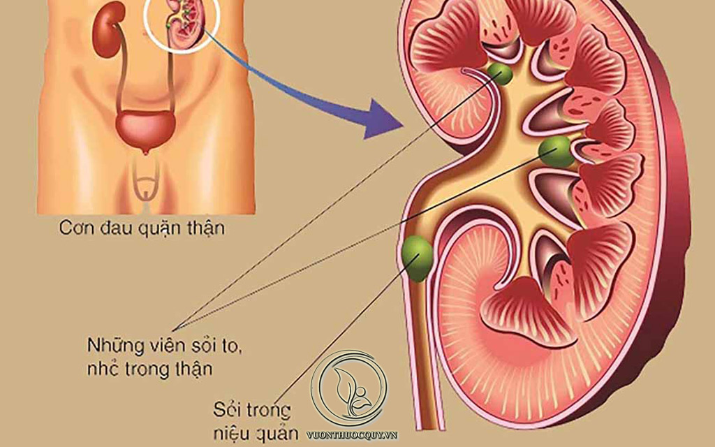Biến Chứng Của Viêm Đường Tiết Niệu
