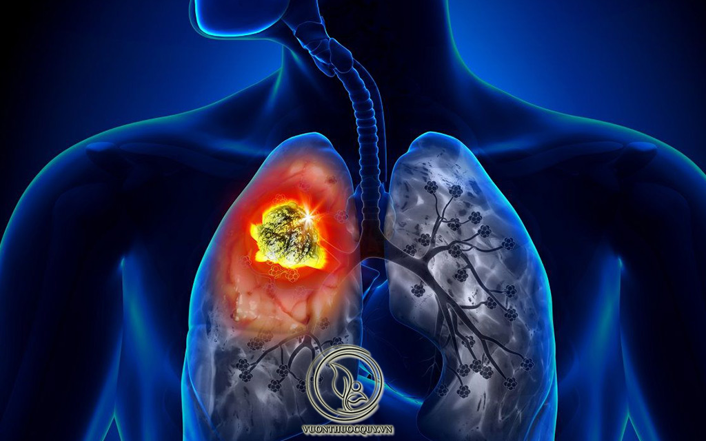Dấu Hiệu Của Ung Thư Phổi