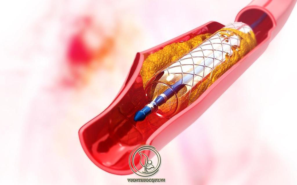 Nguyên Nhân Gây Ra Xơ Vữa Động Mạch