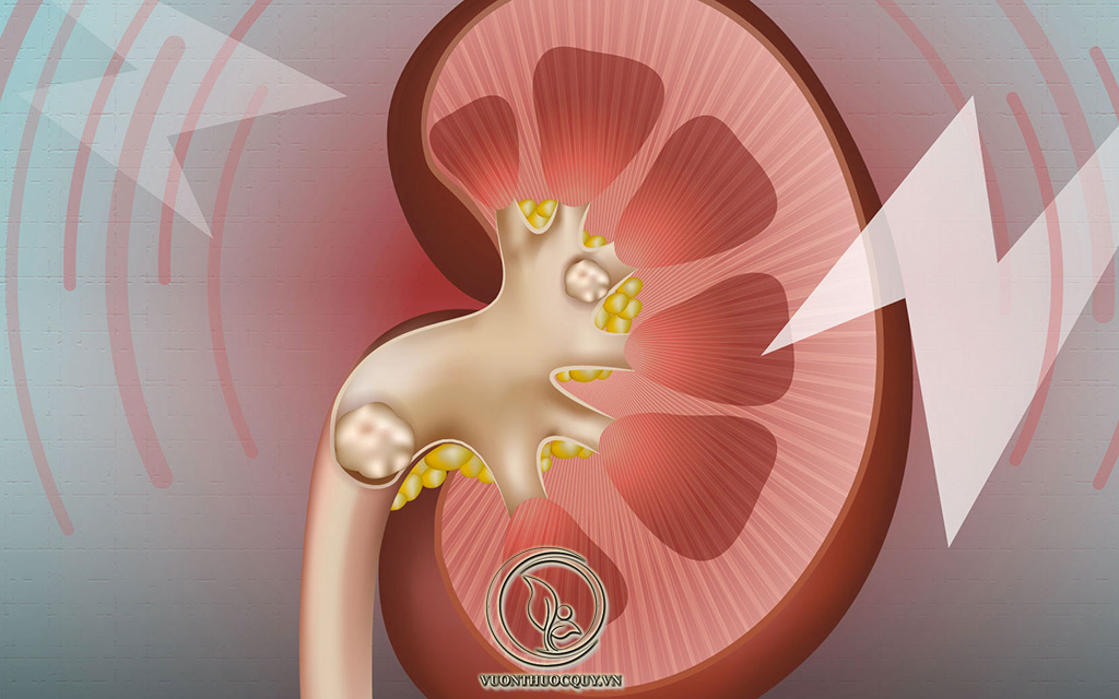 Những Điều Cần Biết Bệnh Sỏi Thận