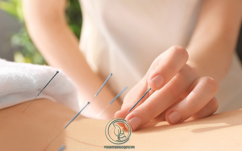 Chữa Đau Vai Gáy Bằng Châm Cứu Là Gì ?