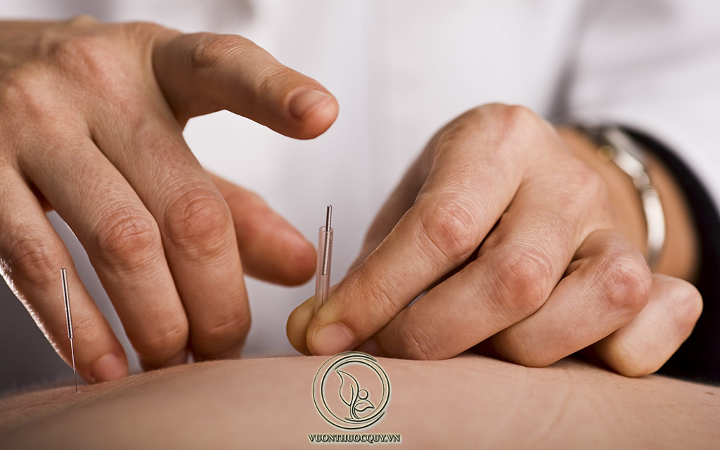 Lợi Ích Của Châm Cứu