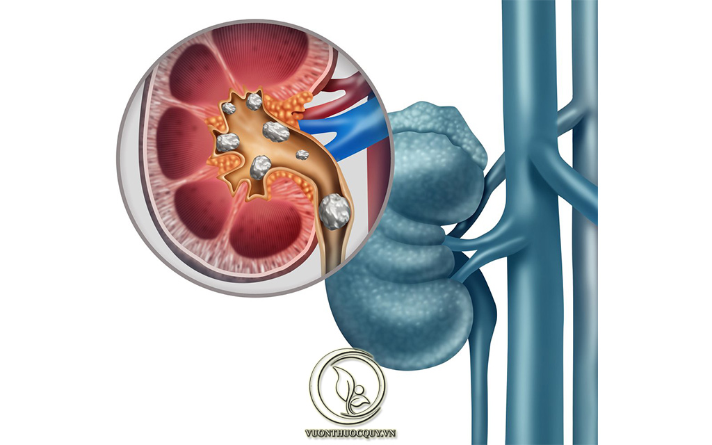 Các Biến Chứng Của Sỏi Niệu Quản