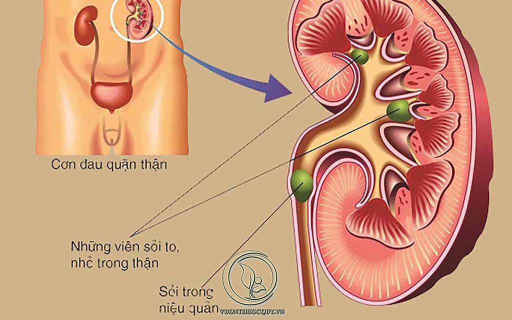 Sỏi Niệu Quản Là Gì ?