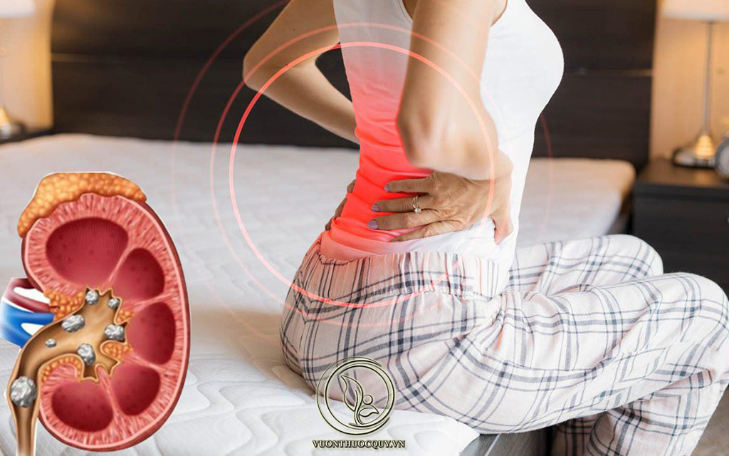 Bệnh Sỏi Thận Có Nguy Hiểm Không ?