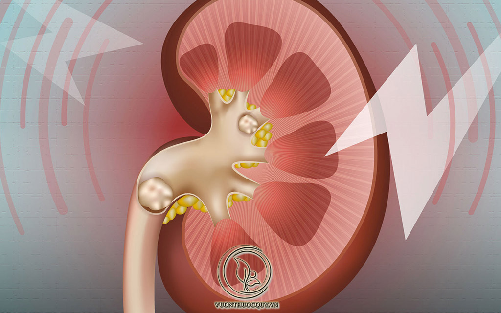 Những Cách Phòng Ngừa Bệnh Sỏi Thận