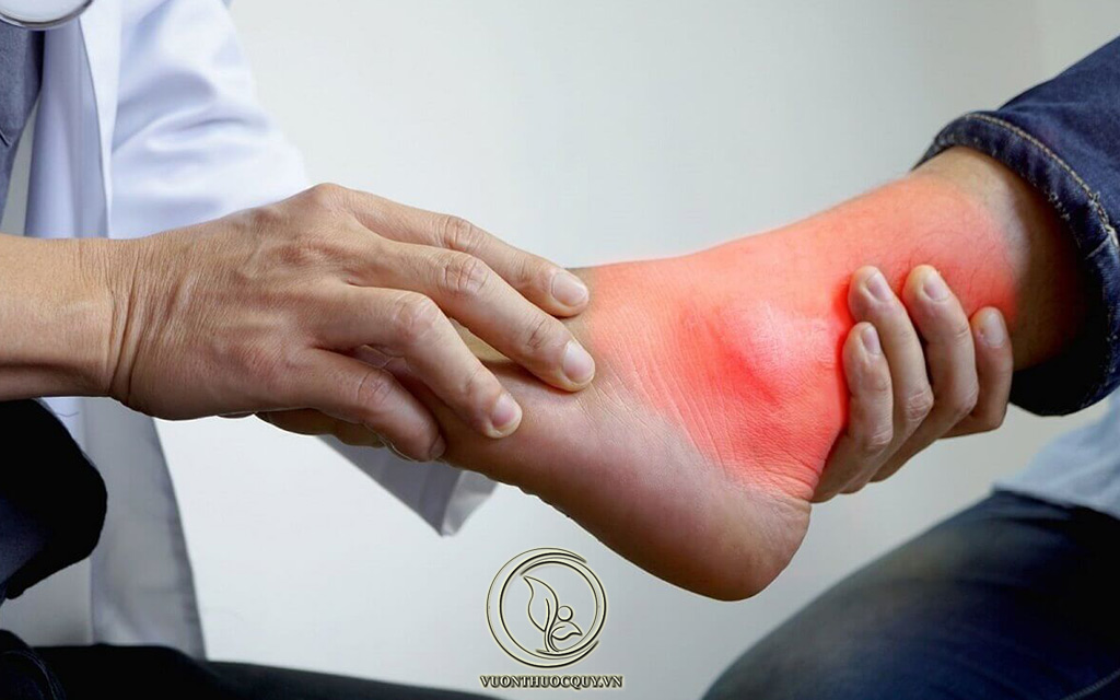 Bệnh Gout Có Khỏi Được Không ?
