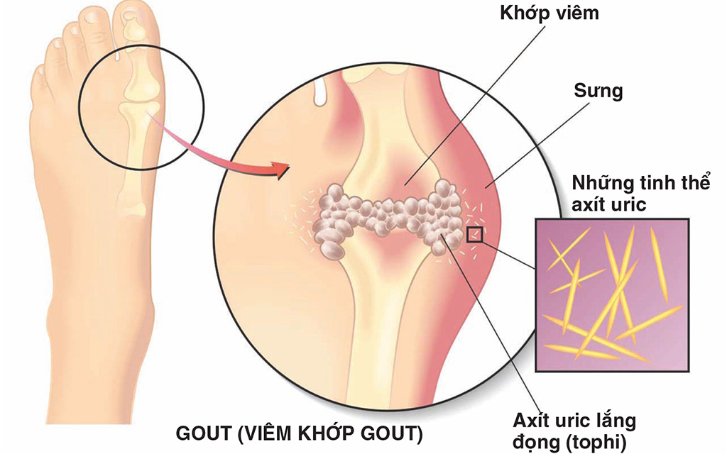Nguyên Nhân Gây Tăng Acid Uric Máu Thường Gặp Ở Bệnh Gout