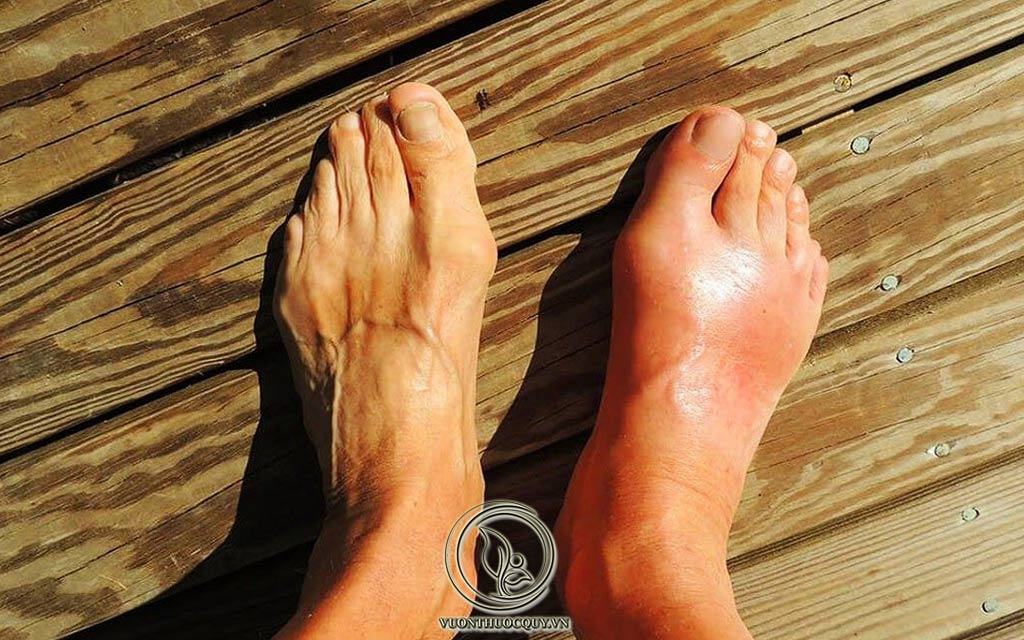 Những Thói Quen Không Ngờ Gây Bệnh Gout