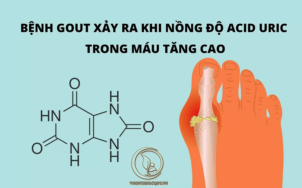 Bệnh Gout Và Suy Thận