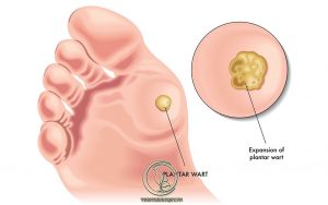 Mụn Nước Ở Ngón Chân Ngứa Là Gì ?