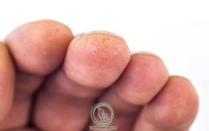 Những Lưu Ý Khi Bị Tổ Đỉa