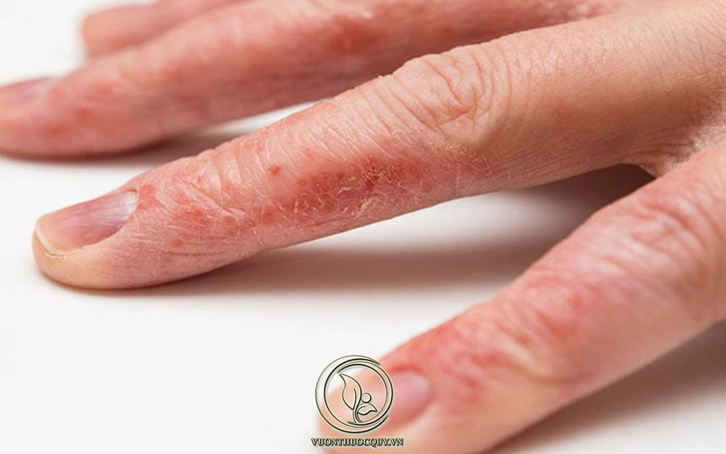 Nổi Mụn Nước Ở Tay Gây Ngứa