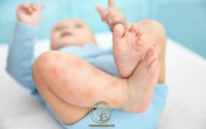 Tìm Hiểu Về Bệnh Tổ Đỉa Ở Trẻ Em