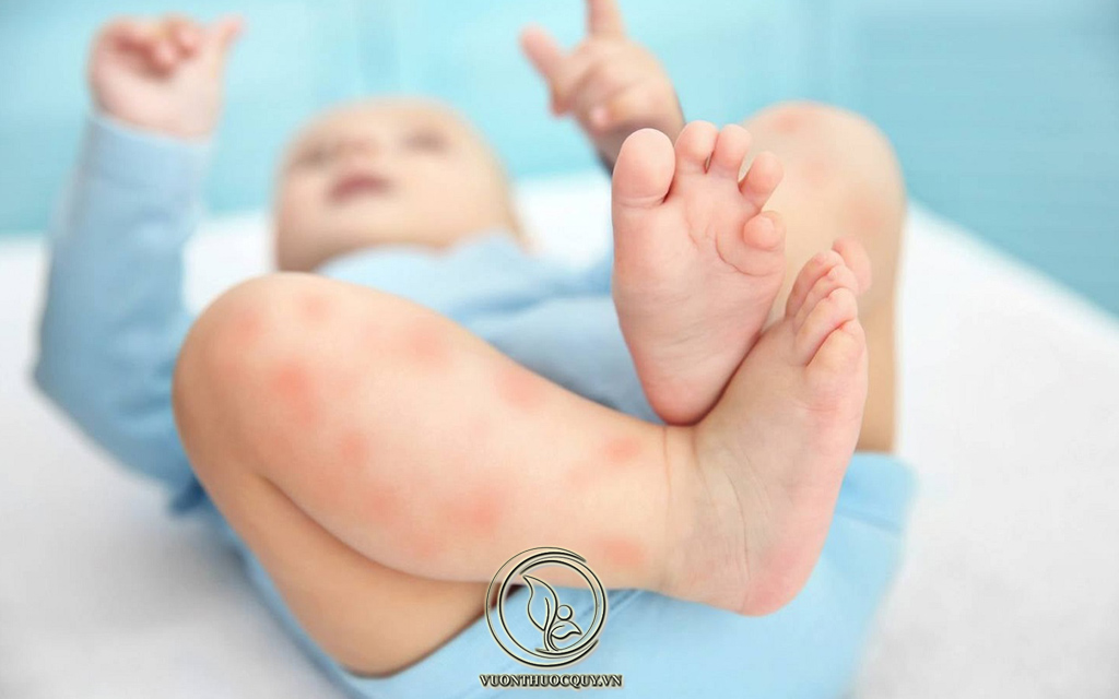 Tìm Hiểu Về Bệnh Tổ Đỉa Ở Trẻ Em